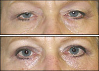 blepharoplasty in tunisia