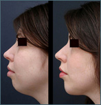 chin implant