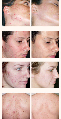 laser treatments tunisia