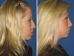 rhinoplasty tunisia