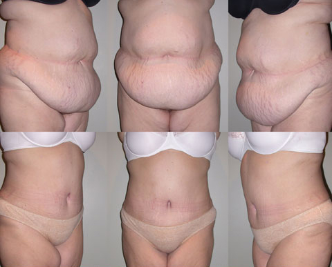 abdominoplasty tunisia,tummy tuck tunisia