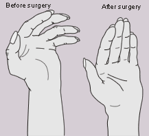 hand surgery