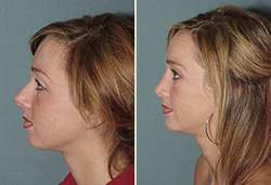 chin implant