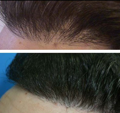 hair transplant tunisia