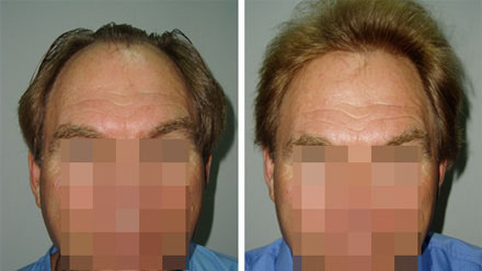 hair transplant tunisia