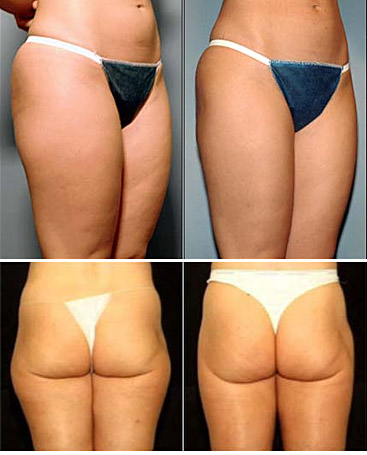 liposuction tunisia