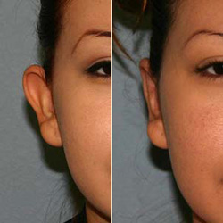 otoplasty tunisia