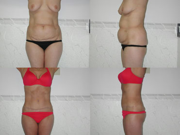 abdominoplasty tunisia,tummy tuck tunisia